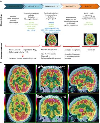 Anti-leucine-rich glioma-inactivated 1 encephalitis revealed by a manic episode: insights from frontal lobe dysfunction in neuropsychiatry through neuropsychology and metabolic imaging. A case report